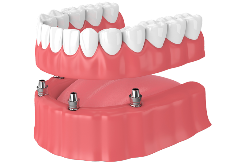 Implant Retained Dentures